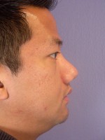 Nose Reshaping Before and after photo