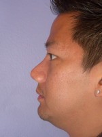 Nose Reshaping Before and after photo