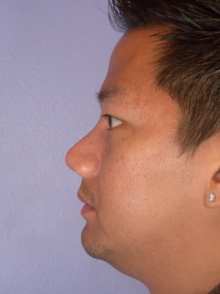 Nose Reshaping before and after photo