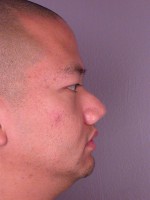 Nose Reshaping Before and after photo