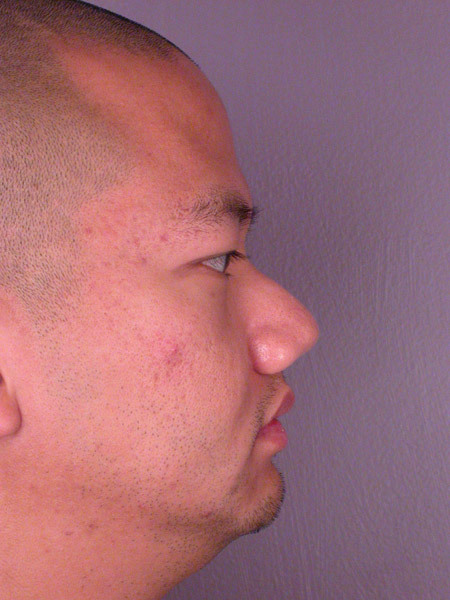 Nose Reshaping before and after photo