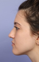 Nose Reshaping