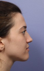 Nose Reshaping Before and after photo