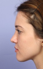 Nose Reshaping Before and after photo