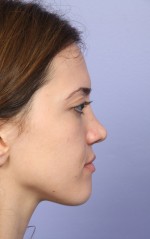 Nose Reshaping Before and after photo