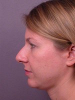 Nose Reshaping Before and after photo