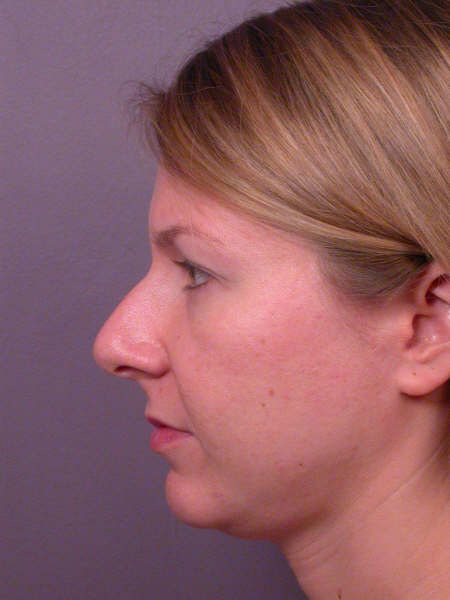 Nose Reshaping before and after photo