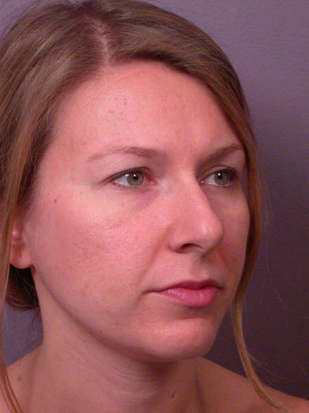 Nose Reshaping before and after photo