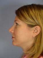 Nose Reshaping Before and after photo