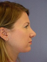 Nose Reshaping Before and after photo