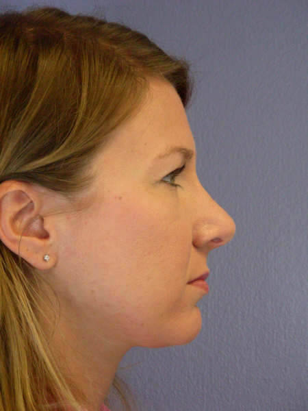 Nose Reshaping before and after photo