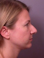 Nose Reshaping Before and after photo