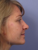 Nose Reshaping Before and after photo