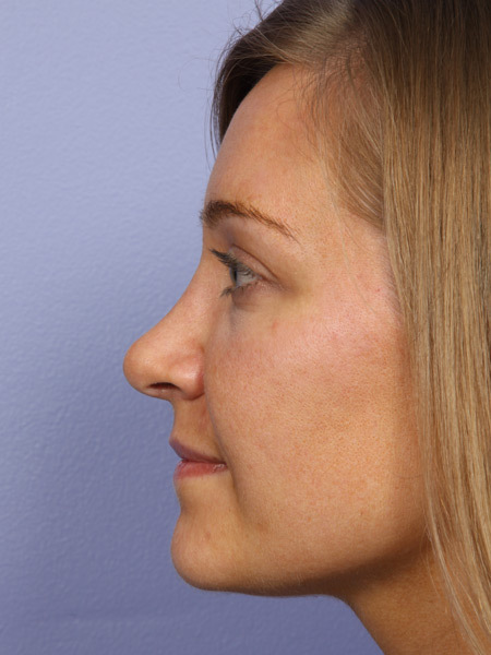 Nose Reshaping before and after photo