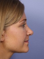 Nose Reshaping Before and after photo