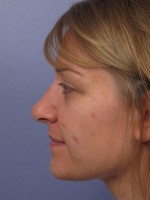 Nose Reshaping Before and after photo