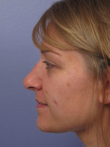 Nose Reshaping before and after photo