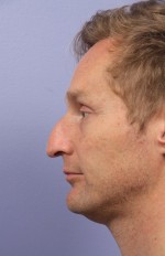 Nose Reshaping