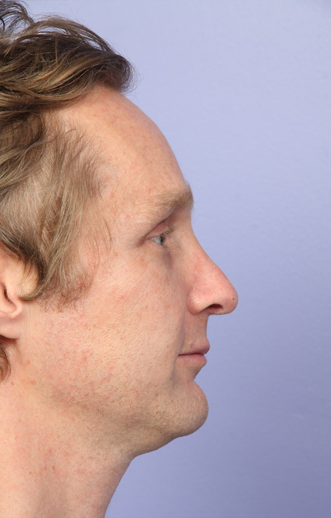 Nose Reshaping before and after photo