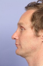 Nose Reshaping