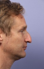 Nose Reshaping Before and after photo