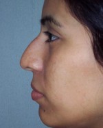 Nose Reshaping Before and after photo