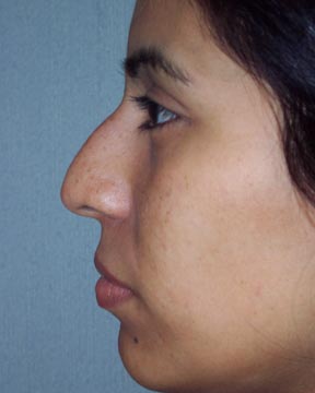 Nose Reshaping before and after photo