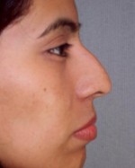 Nose Reshaping