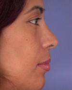 Nose Reshaping Before and after photo