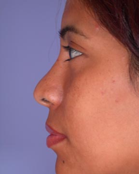 Nose Reshaping before and after photo