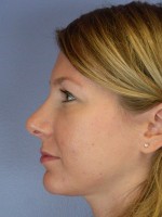 Nose Reshaping Before and after photo