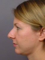 Nose Reshaping Before and after photo