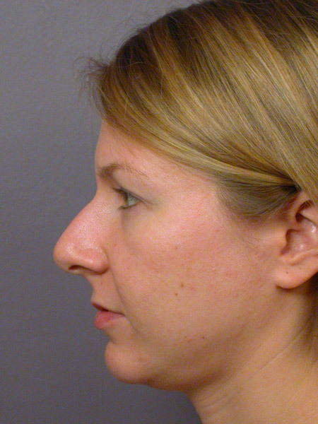 Nose Reshaping before and after photo