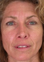 ThermaCool Non-Surgical Facelift