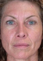 ThermaCool Non-Surgical Facelift Before and after photo