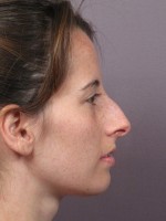 Nose Reshaping Before and after photo