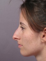 Nose Reshaping Before and after photo