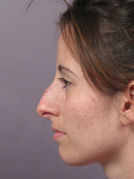 Nose Reshaping before and after photo