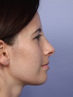 Nose Reshaping Before and after photo