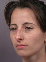 Nose Reshaping Before and after photo