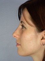 Nose Reshaping Before and after photo