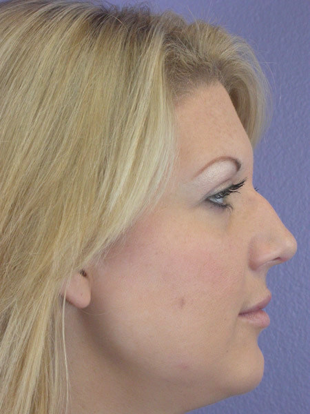 Nose Reshaping before and after photo