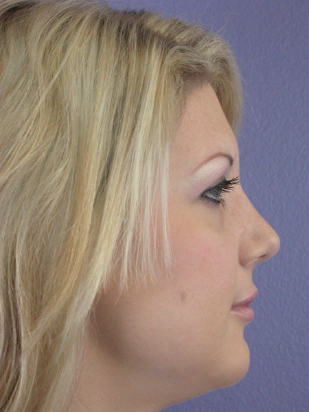 Nose Reshaping before and after photo