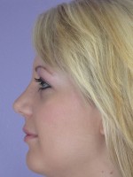 Nose Reshaping Before and after photo