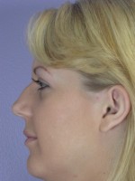 Nose Reshaping Before and after photo