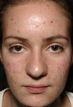 ThermaCool Non-Surgical Facelift Before and after photo