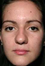 ThermaCool Non-Surgical Facelift Before and after photo
