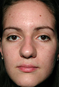 ThermaCool Non-Surgical Facelift before and after photo