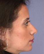 Nose Reshaping Before and after photo