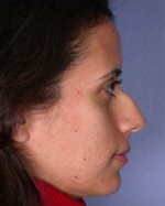 Nose Reshaping Before and after photo